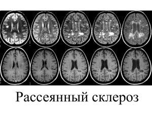 Рассеянный склероз (РС)