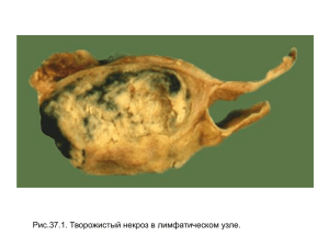 Рис.37.1. Творожистый некроз в лимфатическом узле.