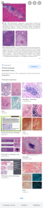 межуточный миокардит микропрепарат – Google Поиск
